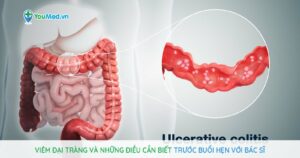 Viêm đại tràng và những điều cần biết trước buổi hẹn với bác sĩ