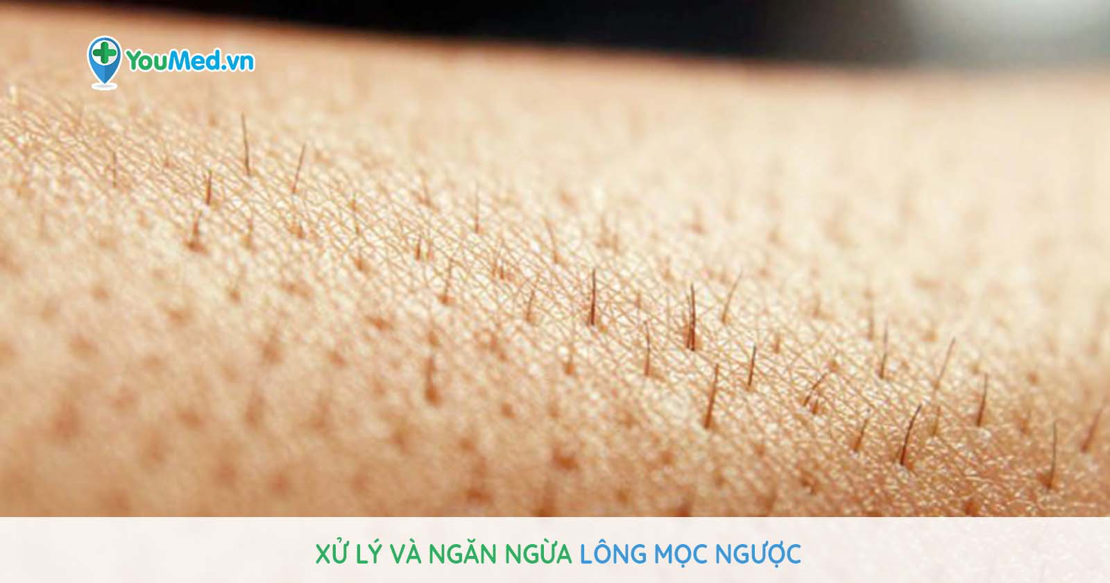 Xử lý và ngăn ngừa bệnh lông mọc ngược thế nào? - YouMed