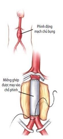 Phẫu thuật thay phình động mạch chủ bằng mạch máu nhân tạo