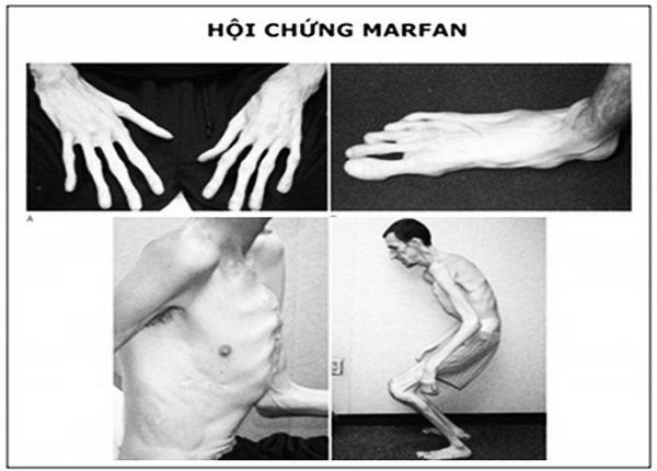 Hội chứng Marfan: bất thường di truyền hiếm gặp và những điều cần biết