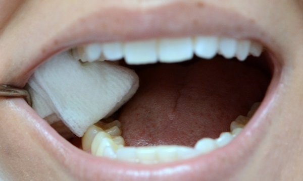 Chăm sóc sau nhổ răng như thế nào để lành thương tốt ?
