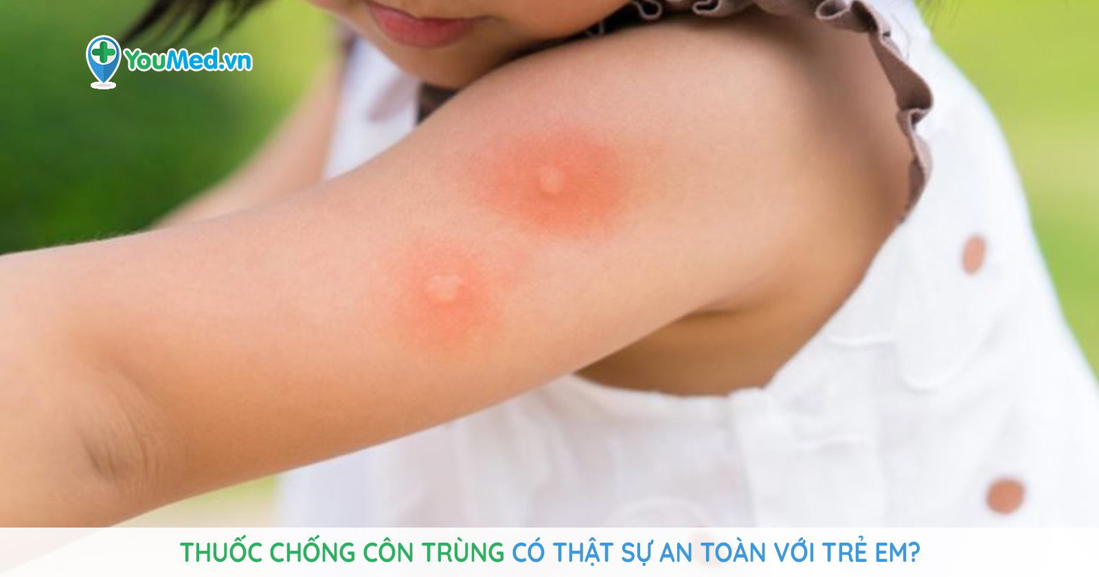 Trẻ bị côn trùng cắn: Bố mẹ nên xử trí thế nào? - YouMed