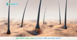 Dày sừng nang lông có nguy hiểm như bạn nghĩ?