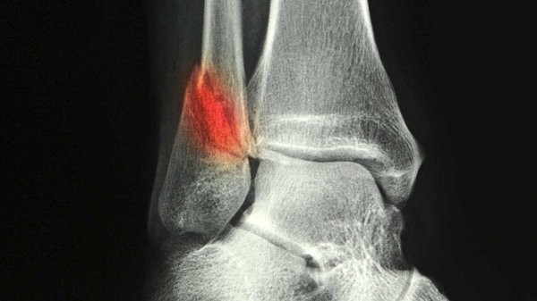 Hình ảnh X quang cho thấy gãy mắt cá ngoài ở cổ chân