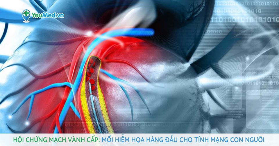 Hội chứng mạch vành cấp: Mối hiểm họa hàng đầu!