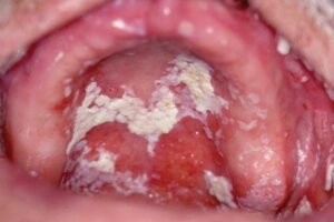 nhiễm nấm trong miệng