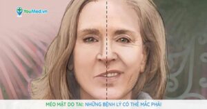 Méo mặt do tai: Những bệnh lý có thể gặp