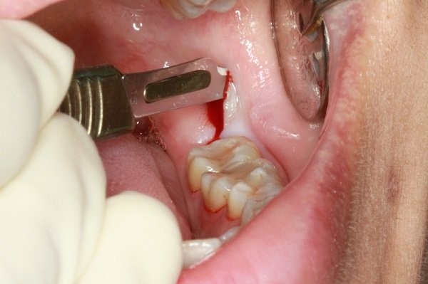 Nhổ răng tiểu phẫu 