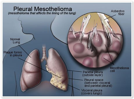 mesothelioma