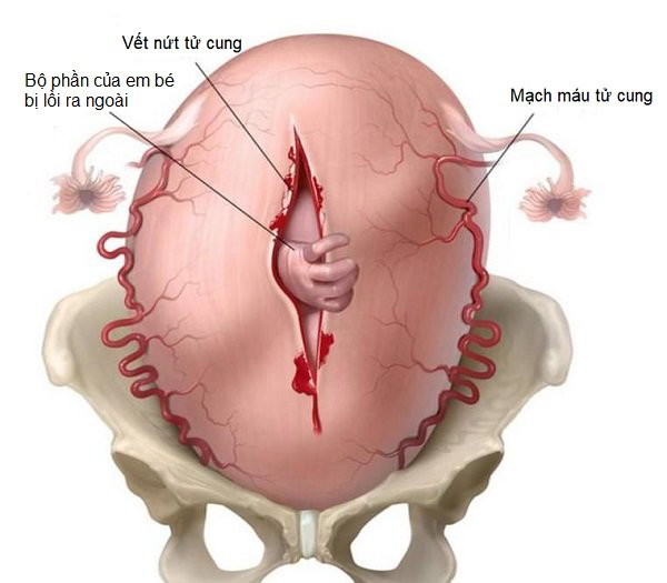 Vỡ tử cung: Mối đe dọa trong ba tháng cuối thai kỳ - YouMed