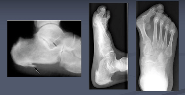 Hình ảnh Xquang bàn chân trong bệnh Viêm khớp phản ứng