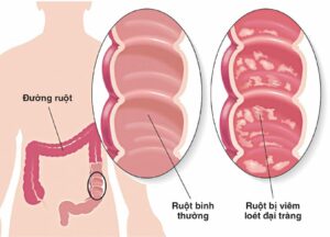 viêm loét đại tràng