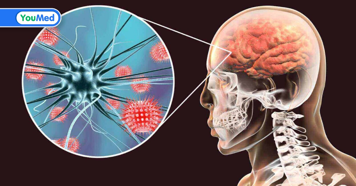 Ai có nguy cơ cao bị nhiễm viêm màng não từ người khác?