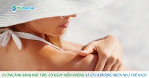 Dị ứng ánh sáng mặt trời có nguy hiểm không và cách phòng ngừa như thế nào?