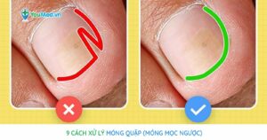 9 cách xử lý móng quặp (móng mọc ngược)