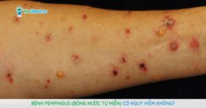Bệnh Pemphigus (bóng nước tự miễn) có nguy hiểm không? Điều trị thế nào?