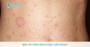 Bệnh vảy phấn hồng có nguy hiểm không?