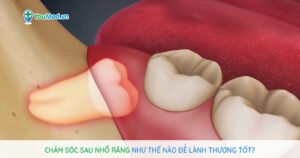 Chăm sóc sau nhổ răng như thế nào để lành thương tốt ?