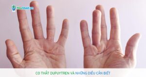 Co thắt Dupuytren và những điều cần biết