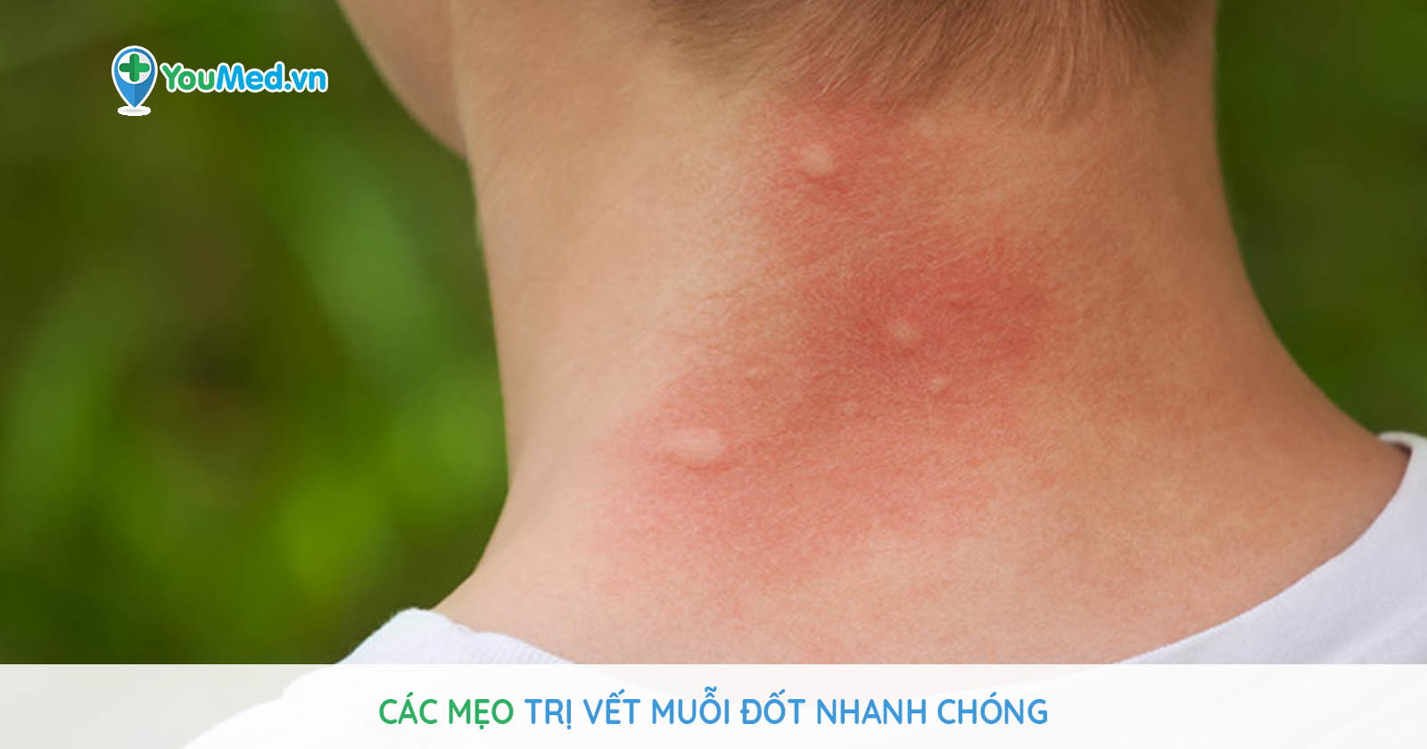 Mẹo trị vết muỗi đốt nhanh chóng và cực hiệu quả - YouMed