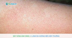 Dày sừng ánh sáng: U lành da không nên xem thường