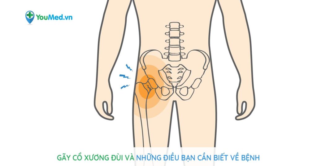 Gãy cổ xương đùi và những điều bạn cần biết về bệnh