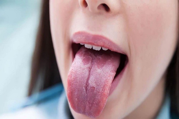 Khô miệng là tác dụng phụ thường gặp