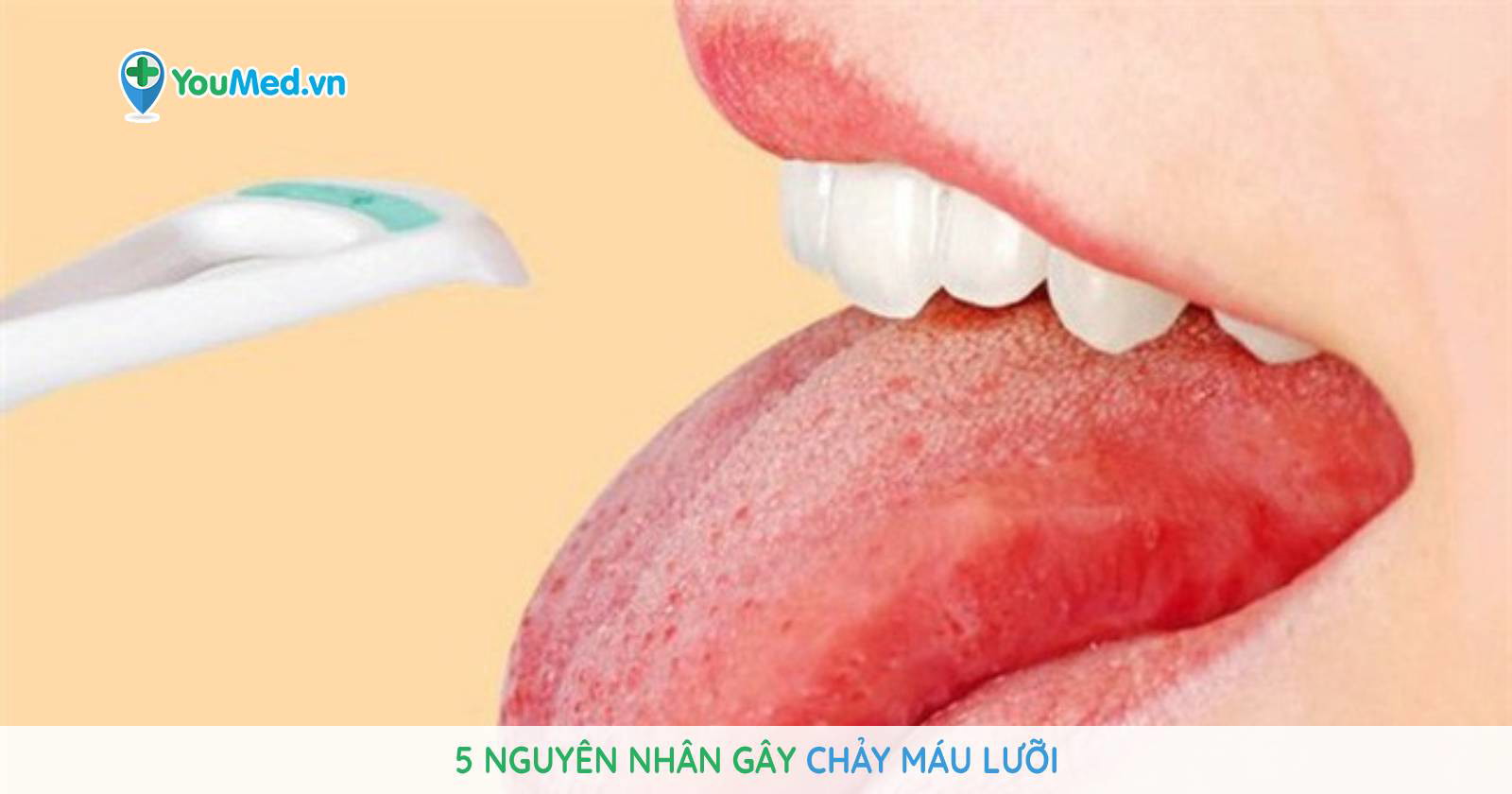 Lưỡi bị chảy máu có thể do những nguyên nhân gì?