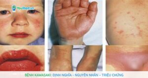 Bệnh Kawasaki: Nguyên nhân, triệu chứng và cách điều trị