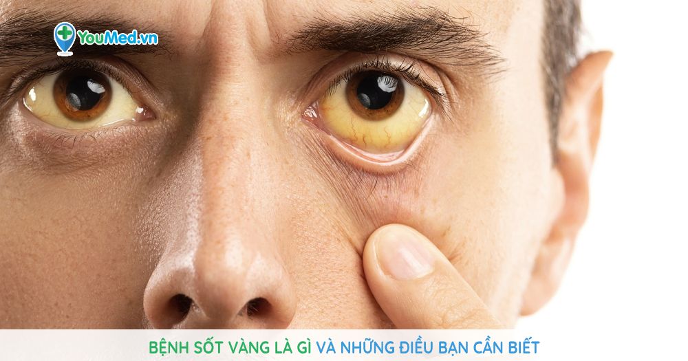 Bệnh sốt vàng là gì và những điều bạn cần biết