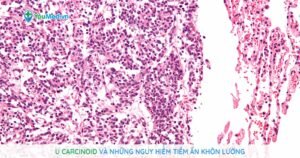 U Carcinoid và những nguy hiểm tiềm ẩn khôn lường