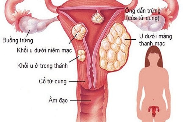 Nhân xơ tử cung thường không thay đổi kích thước khi mang thai