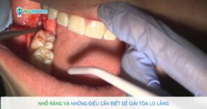 Khi nào nên nhổ răng? Những thông tin cần biết