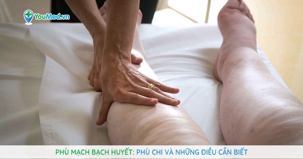 Phù mạch bạch huyết: Phù chi và những điều cần biết