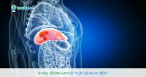 U máu trong gan có thực sự nguy hiểm?