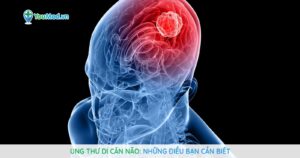 Ung thư di căn não: Những điều bạn cần biết