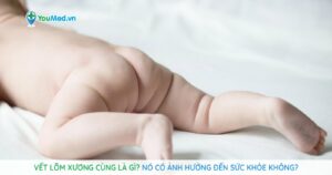 Vết lõm xương cùng là gì? Nó có ảnh hưởng đến sức khỏe không?