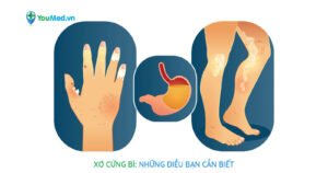 Xơ cứng bì: Những điều bạn cần biết