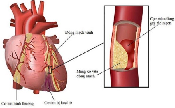 Bệnh tim mạch: Liệu bạn đã thật sự hiểu và biết về nó chưa?