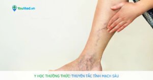 Thuyên tắc tĩnh mạch sâu: Bạn đã biết gì?