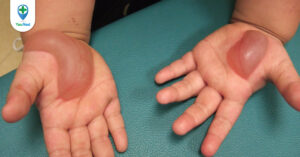 Bệnh ly thượng bì bóng nước: triệu chứng, chẩn đoán và điều trị