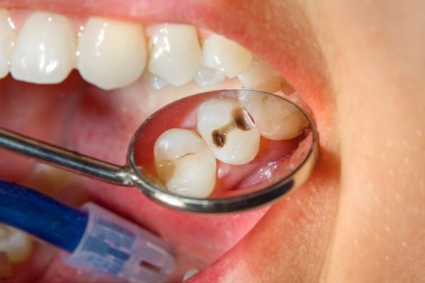 Không nên xem thường bệnh răng miệng này