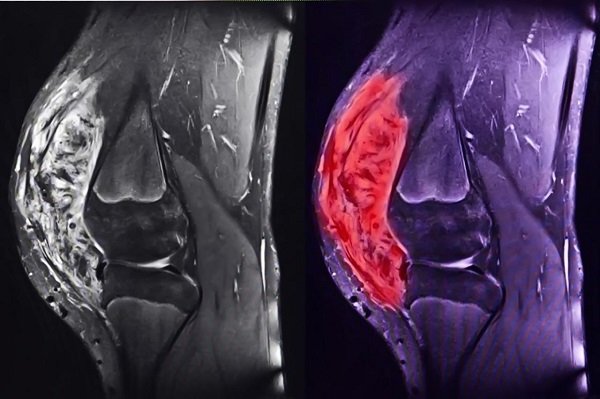 Sarcoma xuất nguồn từ trung mô