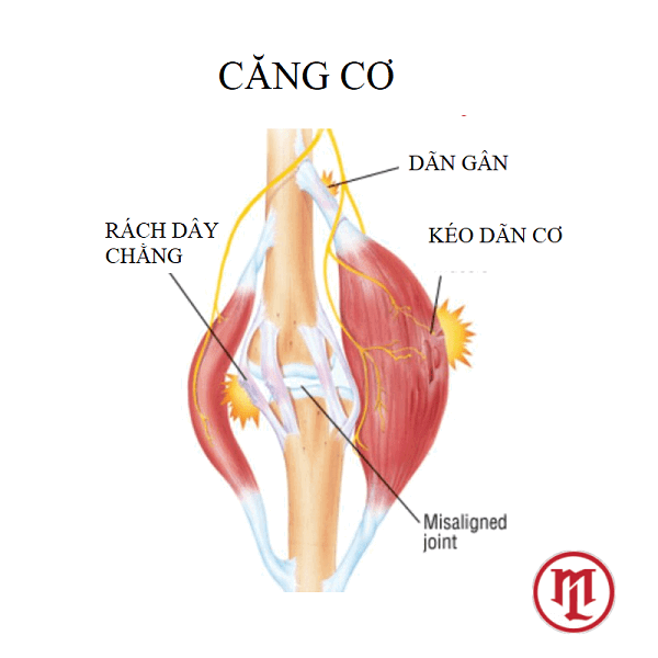 căng cơ