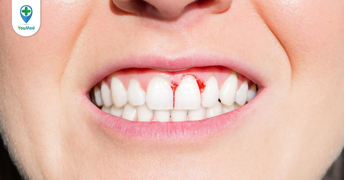 Các biểu hiện và triệu chứng của chảy máu chân răng trong thai kỳ?
