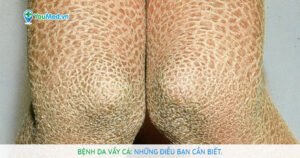 Bệnh da vẩy cá là gì? Cách để có làn da đẹp hơn