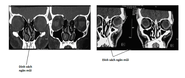 Hình ảnh dính các xoăn mũi và vách ngăn mũi mới nhau trên CT scan.