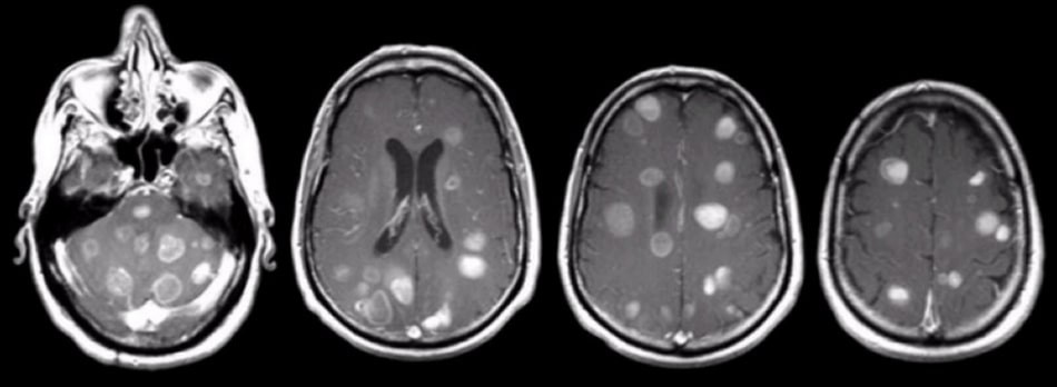 Hình ảnh chụp cắt lớp điện toán ở một bệnh nhân ung thư phổi di căn não