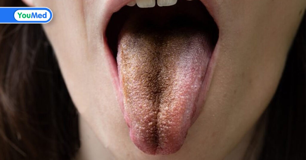 Lưỡi bị đen là gì và 8 cách xử trí hiệu quả