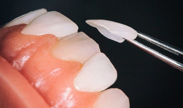 mẻ răng phục hồi bằng mặt dán sứ